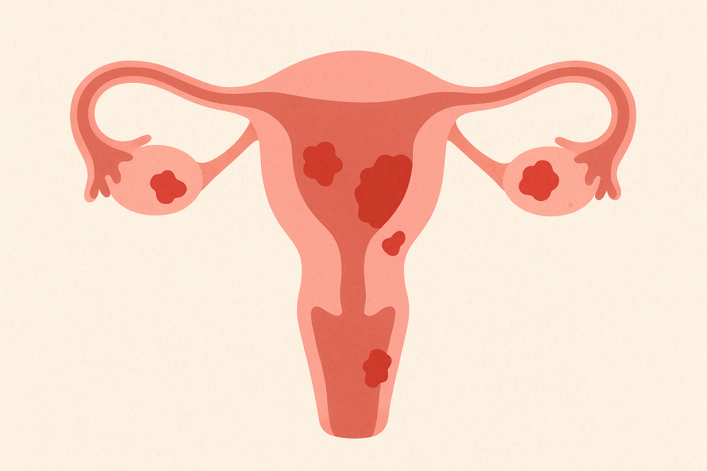 An image of a female reproductive organ with endometriosis